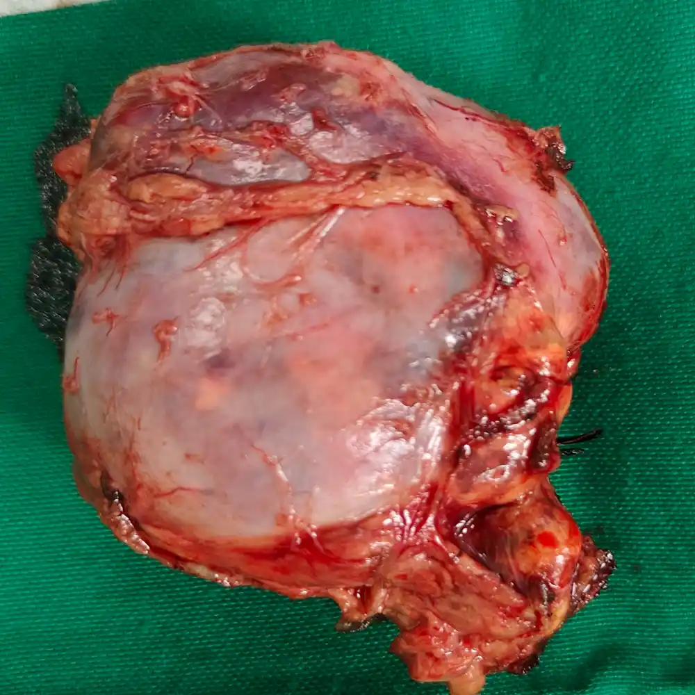 Complex Bilateral Adrenalectomy For Functioning Pheochromocytomas In A High Risk Patient3 1
