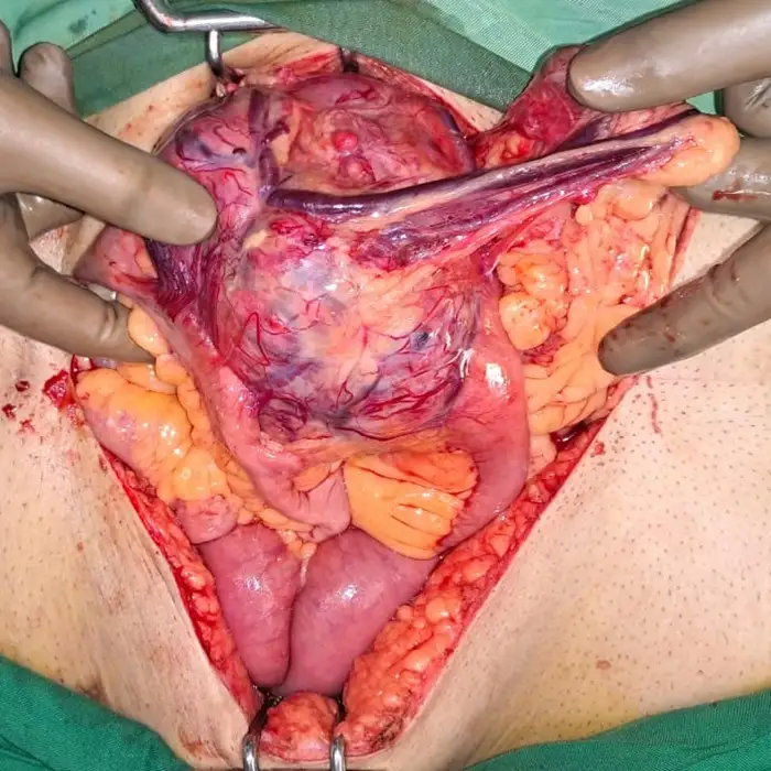 Complex Cytoreductive Surgery and Partial Nephrectomy for Metastatic Renal Cell Carcinoma1 1