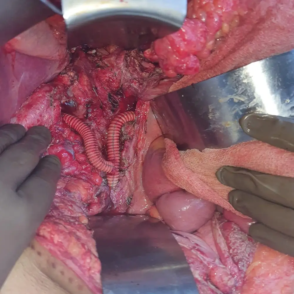 Complex Reconstruction After IVC Tumour Resection for De Differentiated Liposarcoma1 1