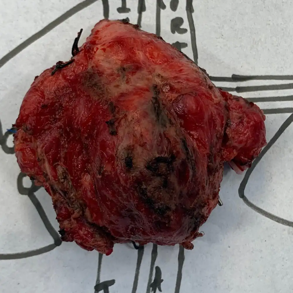 Complex Reconstruction After IVC Tumour Resection for De Differentiated Liposarcoma2 1