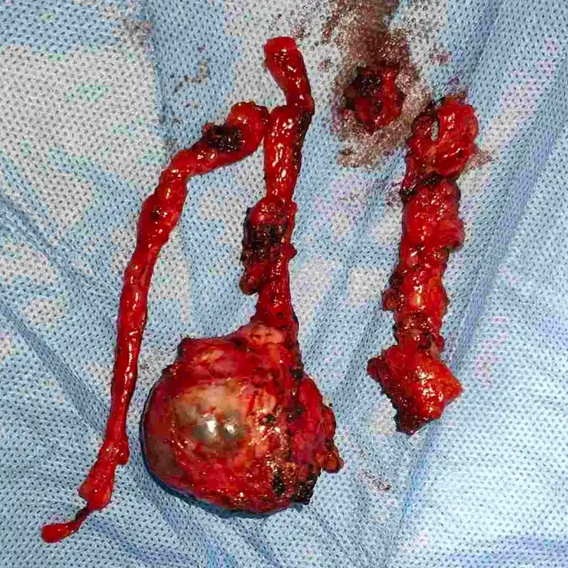 Complex Retroperitoneal Mass Resection And Complete RPLND For Recurrent Germ Cell Tumor1 1
