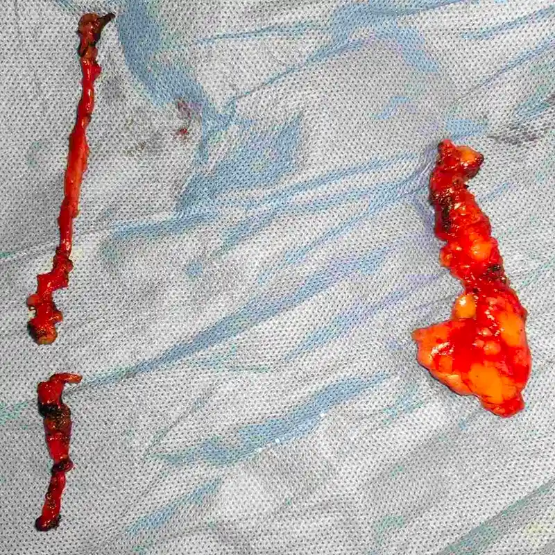 Complex Retroperitoneal Mass Resection And Complete RPLND For Recurrent Germ Cell Tumor2 1