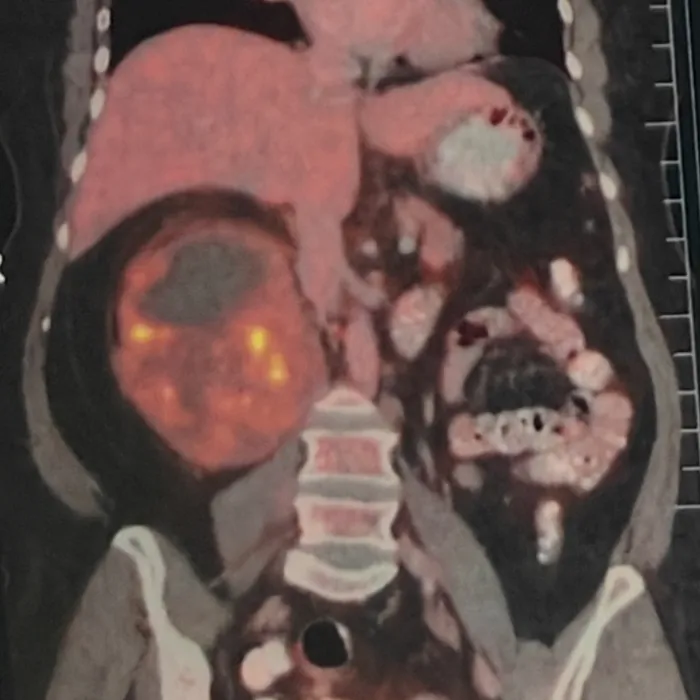 Complex Retroperitoneal Mass Resection And Lymph Node Dissection For Smooth Muscle Sarcoma1 1