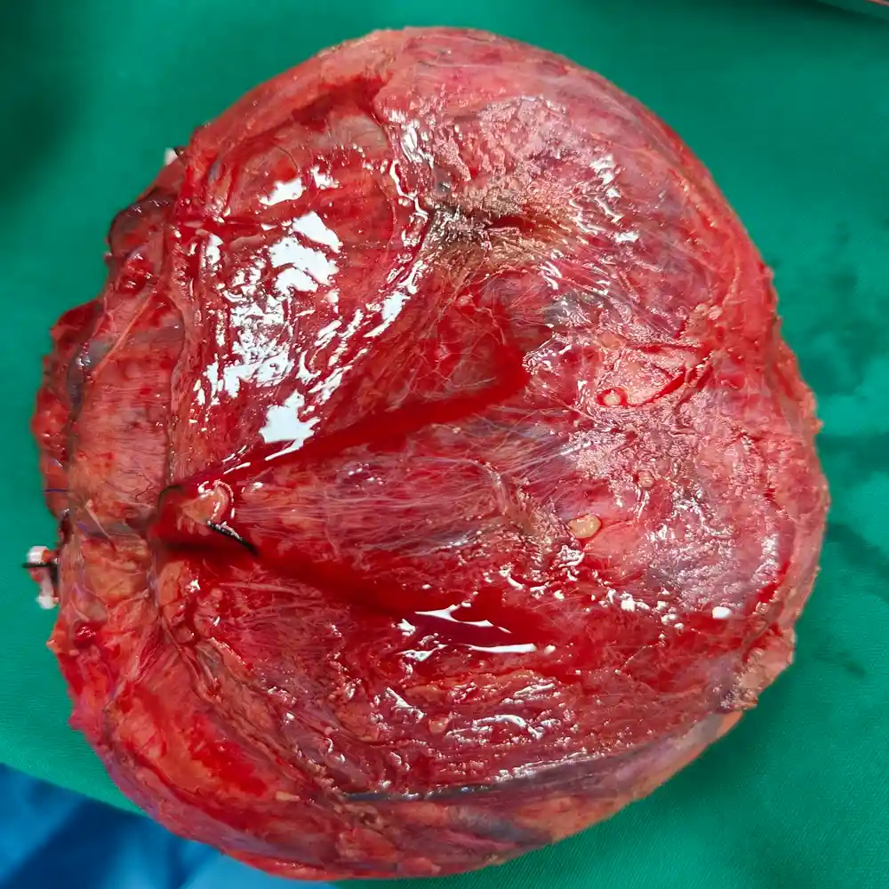 Complex Retroperitoneal Mass Resection And Lymph Node Dissection For Smooth Muscle Sarcoma2 1