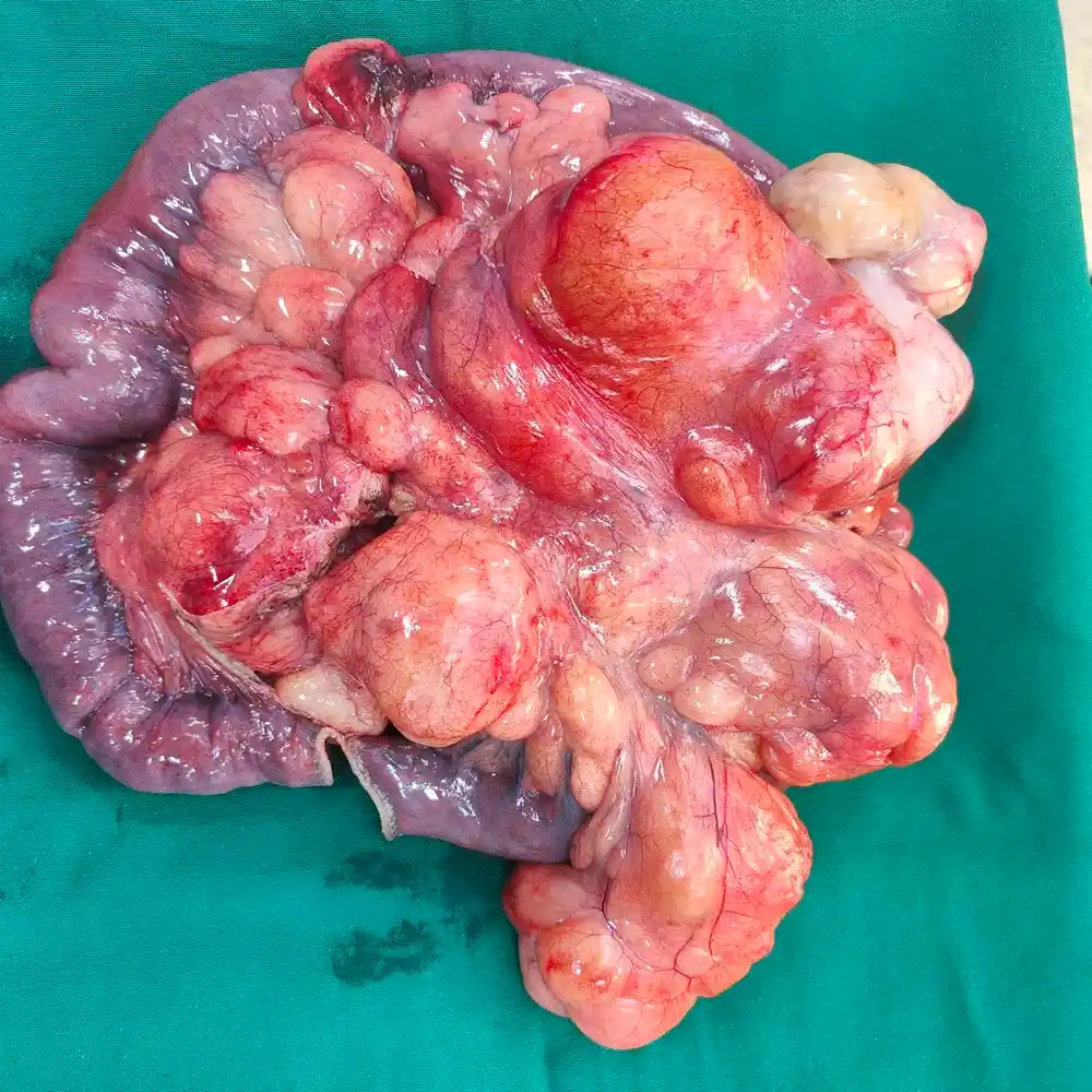 Complex Retroperitoneal Mass Resection and Bowel Reconstruction for Advanced Liposarcoma1 1