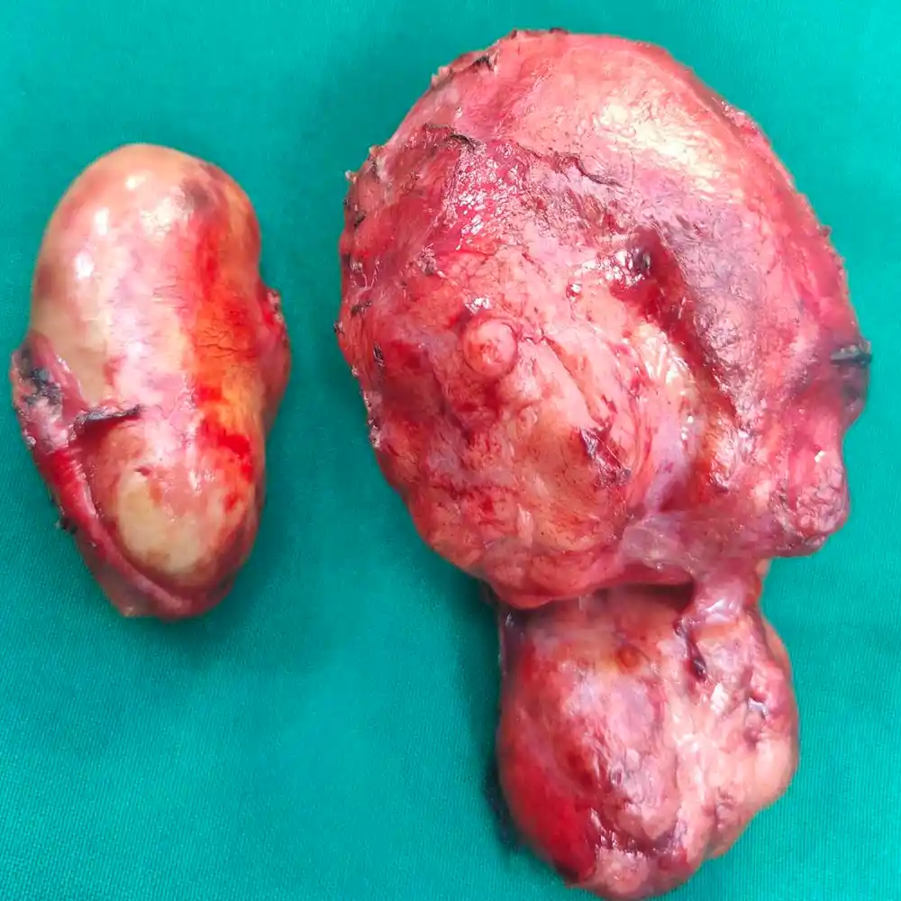 Complex Retroperitoneal Mass Resection and Bowel Reconstruction for Advanced Liposarcoma2 1
