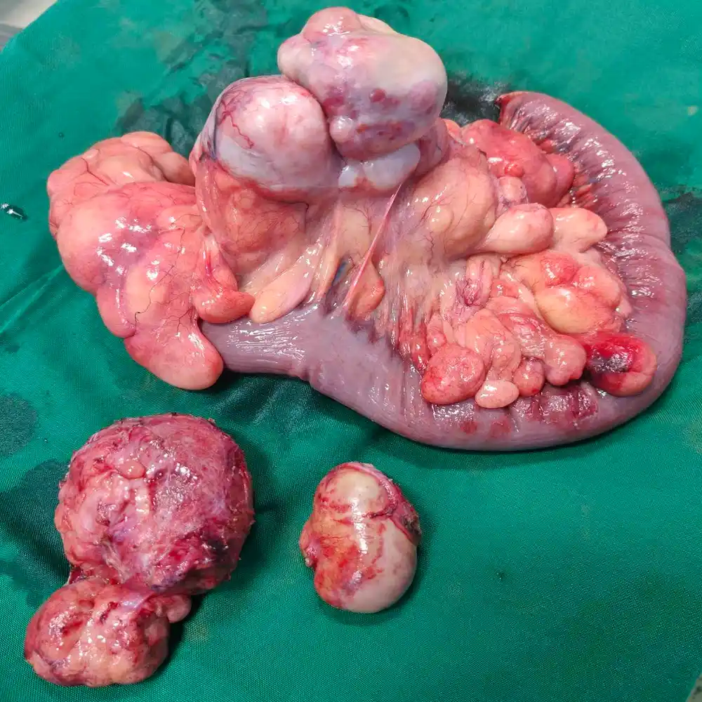 Complex Retroperitoneal Mass Resection and Bowel Reconstruction for Advanced Liposarcoma3 1