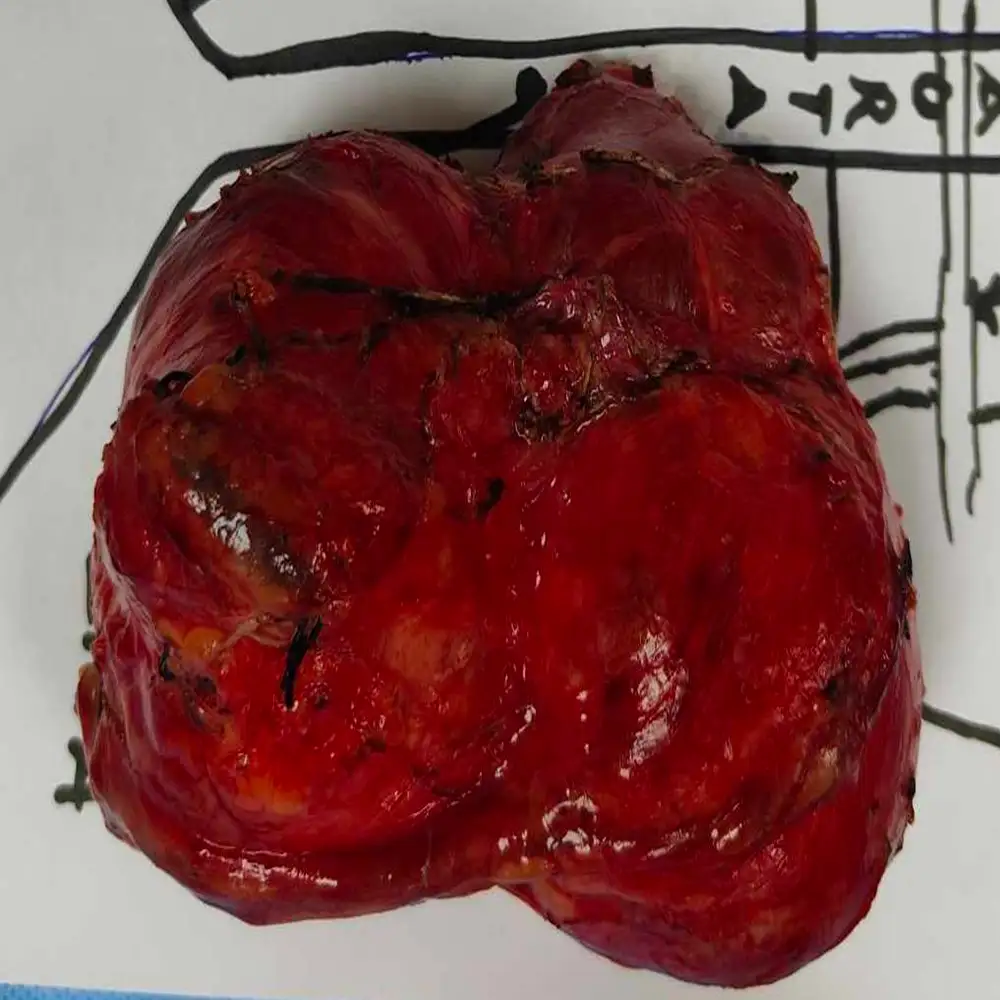 Complex Retroperitoneal Mass Resection with Advanced Retroperitoneal Lymph Node Dissection 1