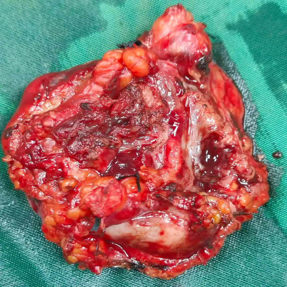 Complex Retroperitoneal Tumor Excision with Bowel and Ureteric Reconstruction for Advanced Sarcoma1 1
