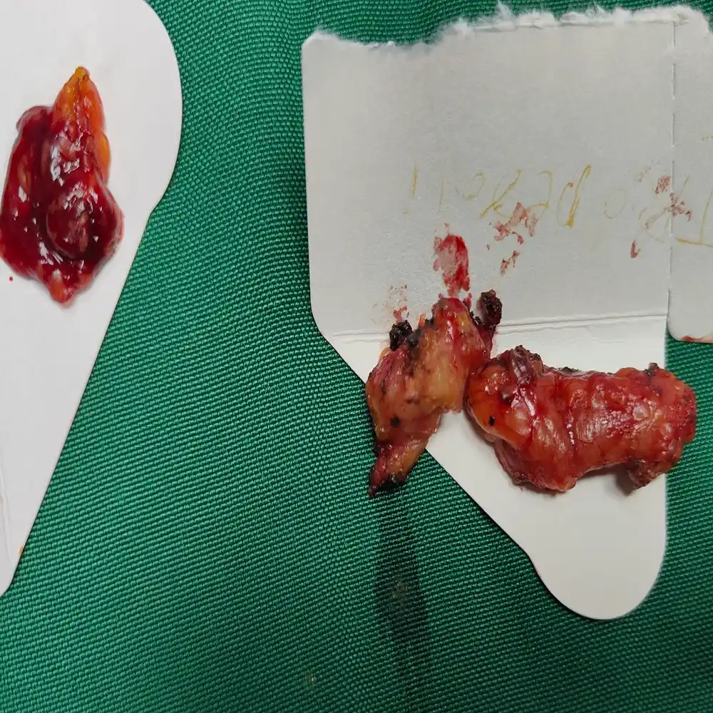 Complex Retroperitoneal Tumor Excision with Bowel and Ureteric Reconstruction for Advanced Sarcoma2 1