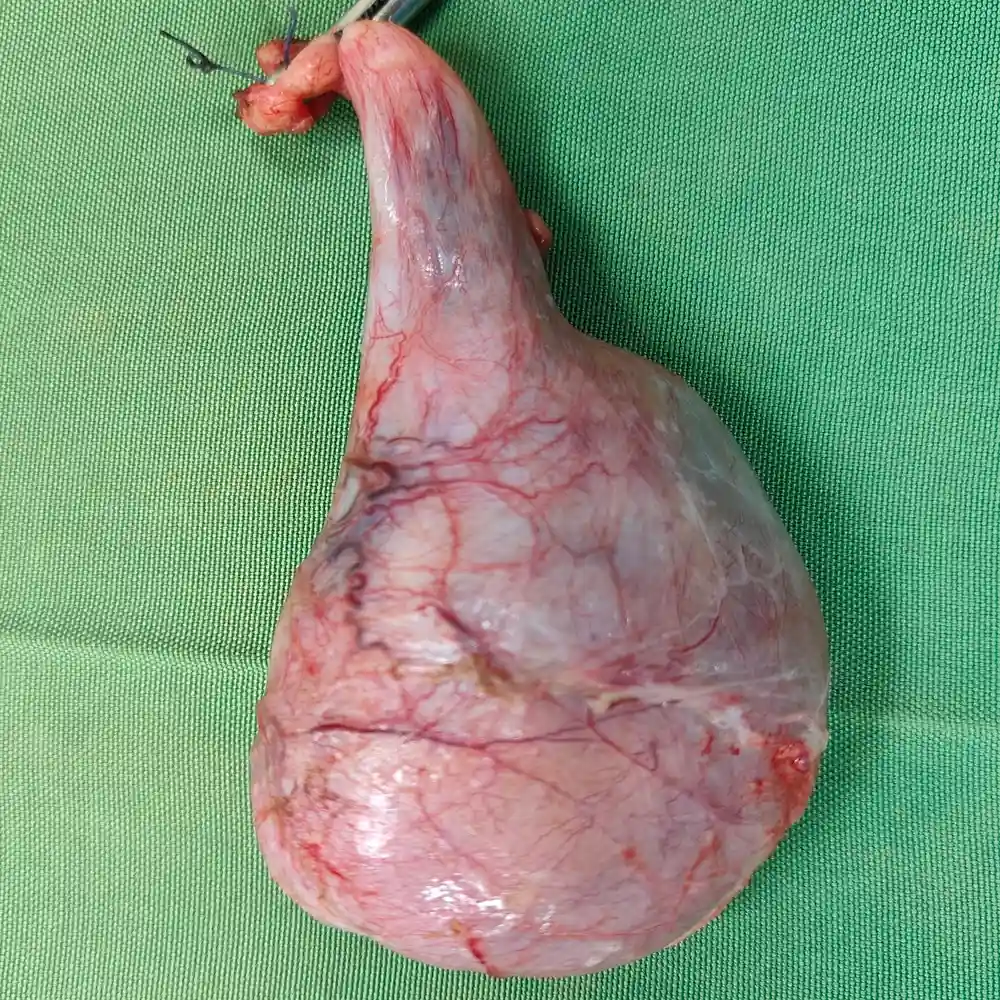 High Inguinal Orchidectomy for Aggressive Non Seminomatous Germ Cell Tumor