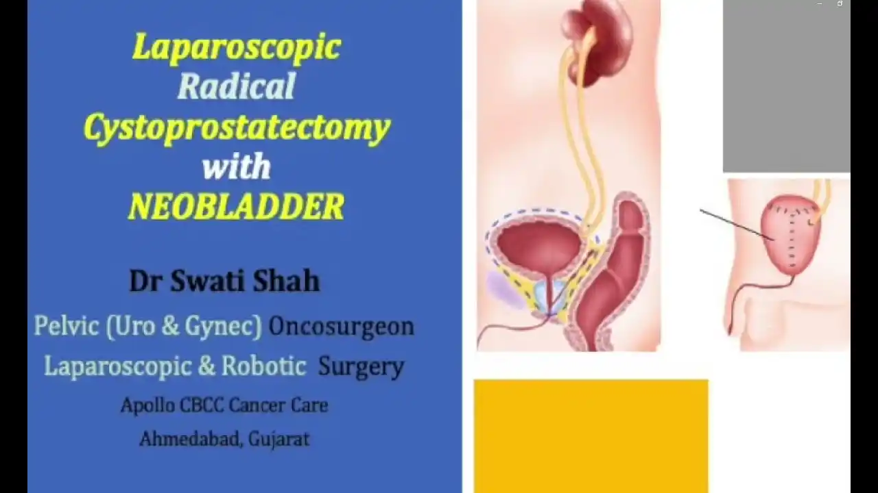 Laparoscopic Radical Cystoprostatectomy with Neobladder