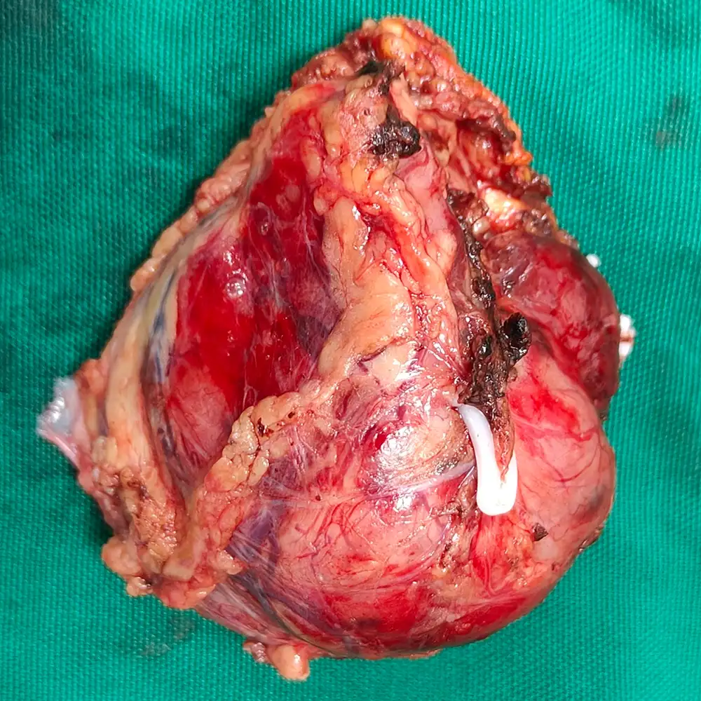 Laparoscopic Retroperitoneal Mass Excision Total Abdominal Hysterectomy and Bilateral Adnexal Resection for Complex Adnexal Masses and Left Suprarenal Tumor 1