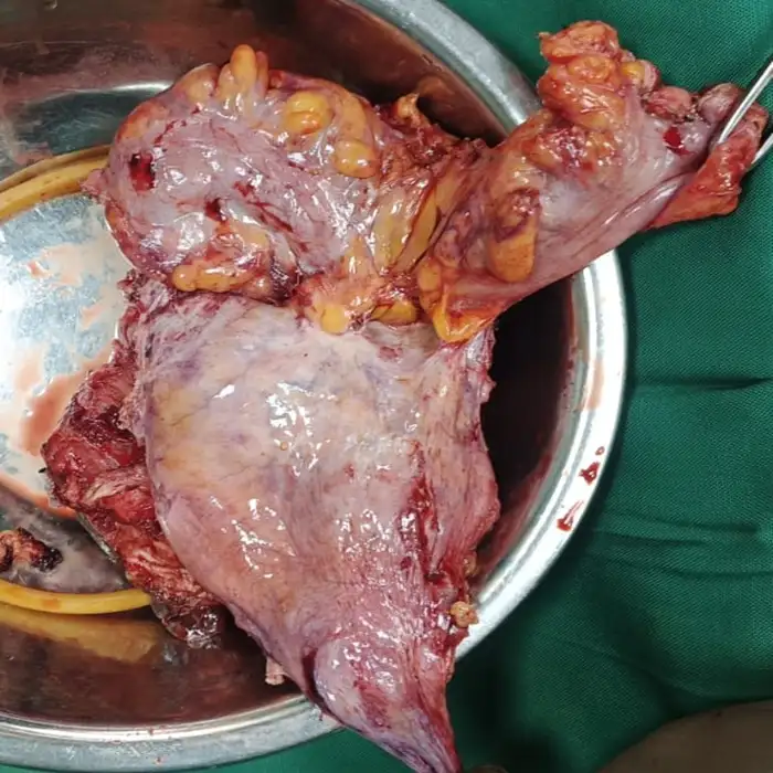 Multi-Organ Resection and Complex Reconstruction via Robotic Total Pelvic Exenteration