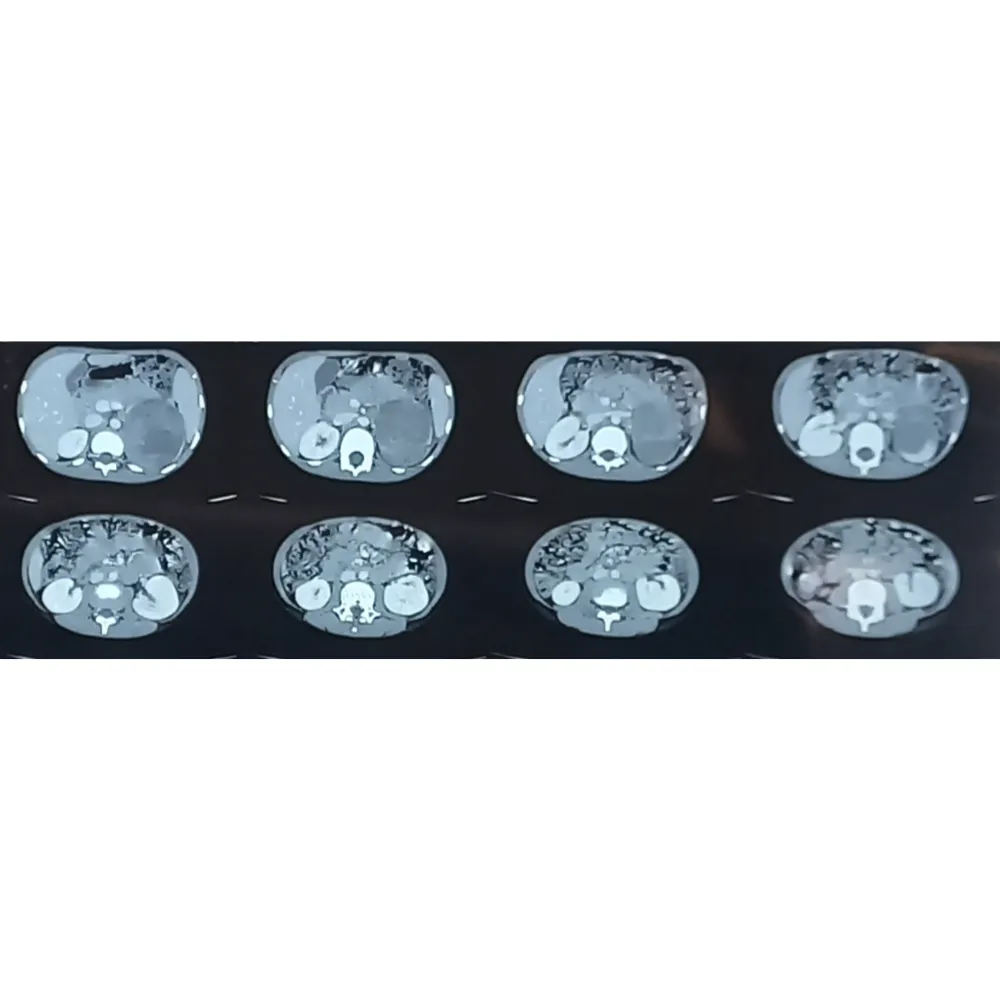 Open Radical Adrenalectomy And Retroperitoneal Lymph Node Dissection For High Grade Pediatric Neuroblastoma1 1
