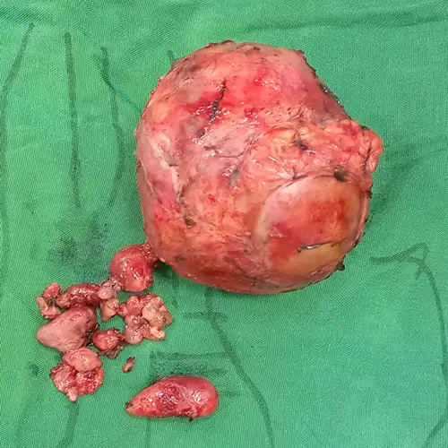 Open Radical Adrenalectomy And Retroperitoneal Lymph Node Dissection For High Grade Pediatric Neuroblastoma2 1