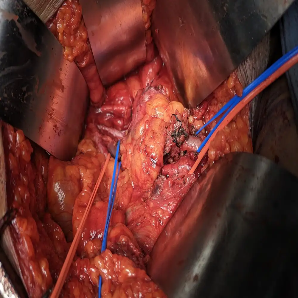 Resection of Right Pelvic Sarcoma with External Iliac Vein Reconstruction Using Dacron Graft1