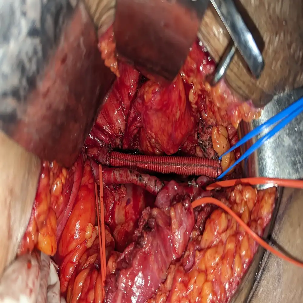 Resection of Right Pelvic Sarcoma with External Iliac Vein Reconstruction Using Dacron Graft2