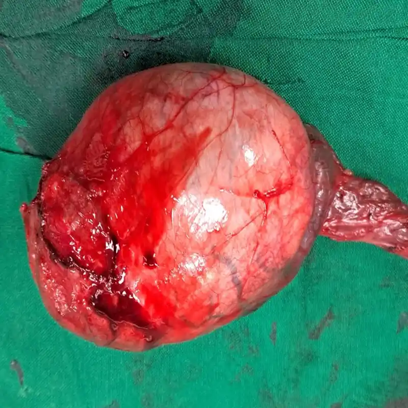 Right High Inguinal Orchidectomy for Classical Testicular Seminoma