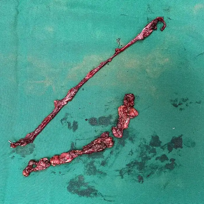 Robotic Nerve Sparing Retroperitoneal Lymph Node Dissection for Paratesticular Rhabdomyosarcoma
