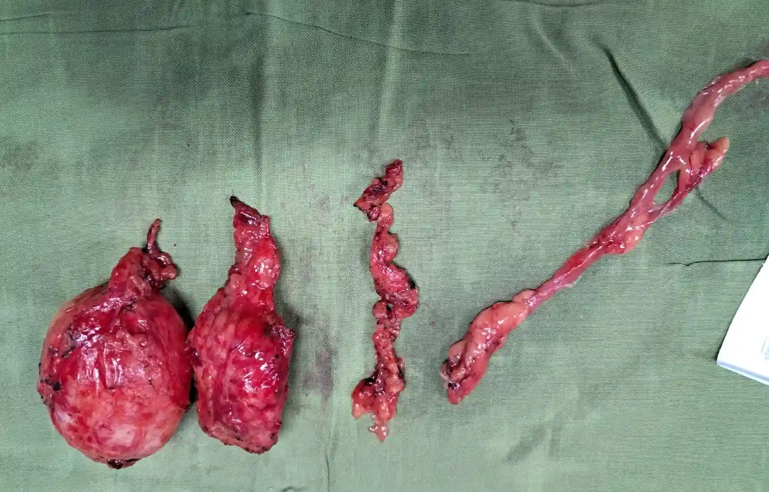 Robotic RPLND for Post Chemotherapy Residual Metastatic Germ Cell Tumor