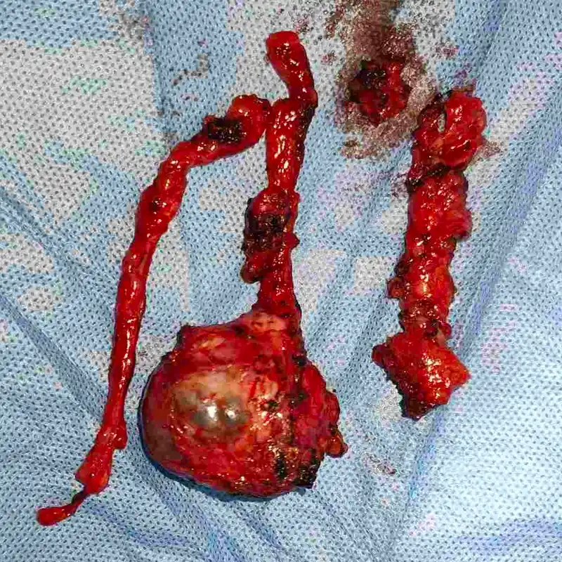 Robotic RPLND for Residual Metastatic Mature Teratoma