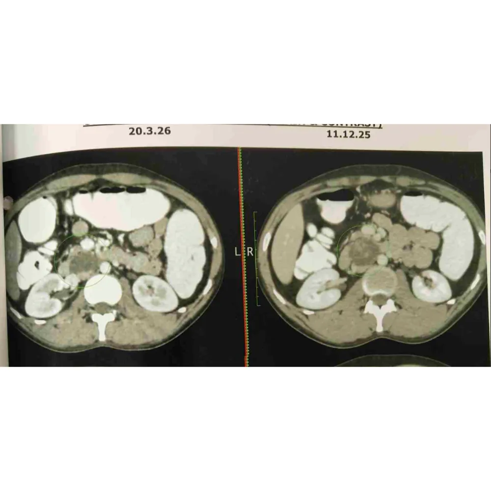 Robotic RPLND for Residual Metastatic Mature Teratoma1
