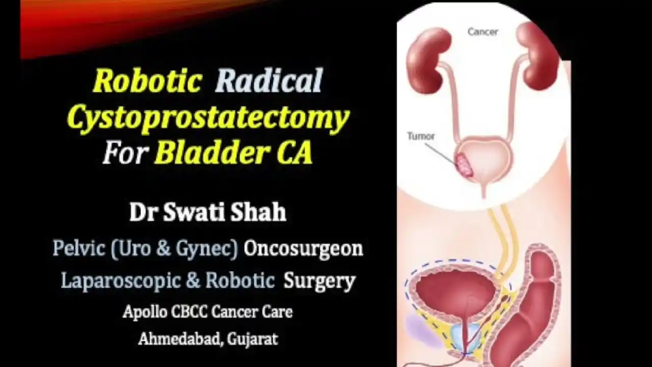 Robotic Radical Cystoprostatectomy For Bladder CA