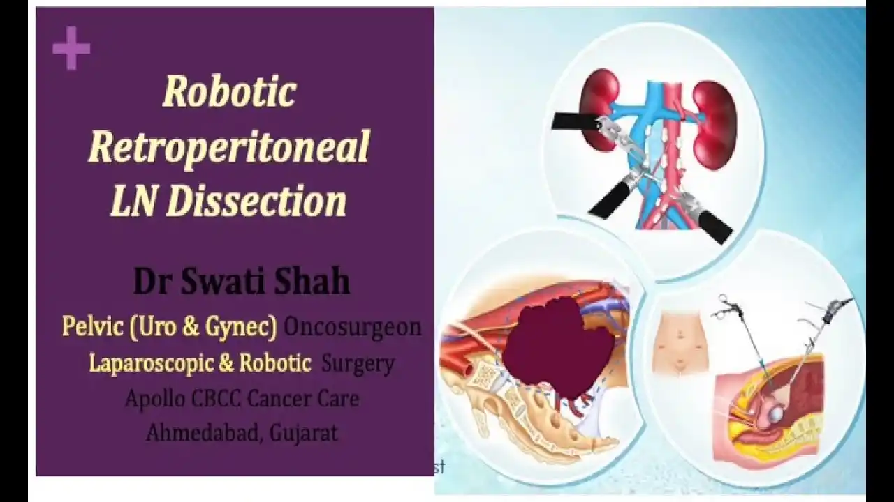 Robotic Retroperitoneal LN Dissection