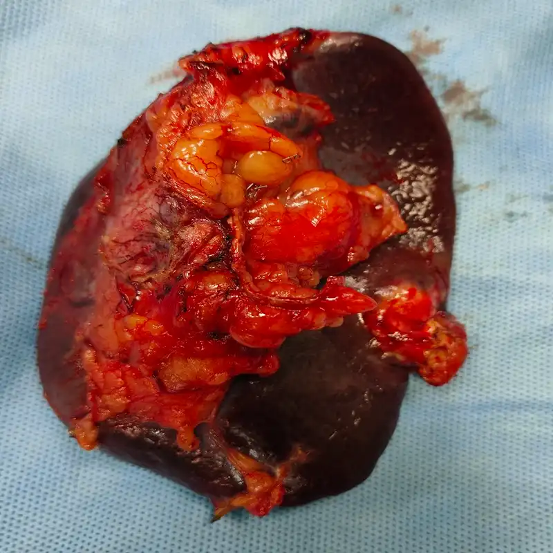 Robotic Retroperitoneal Lymph Node Dissection with Distal Pancreatectomy