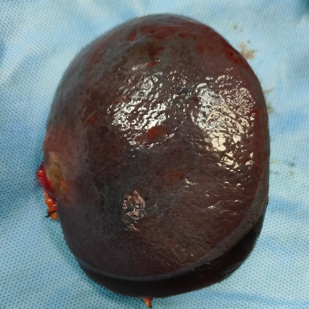 Robotic Retroperitoneal Lymph Node Dissection with Distal Pancreatectomy1