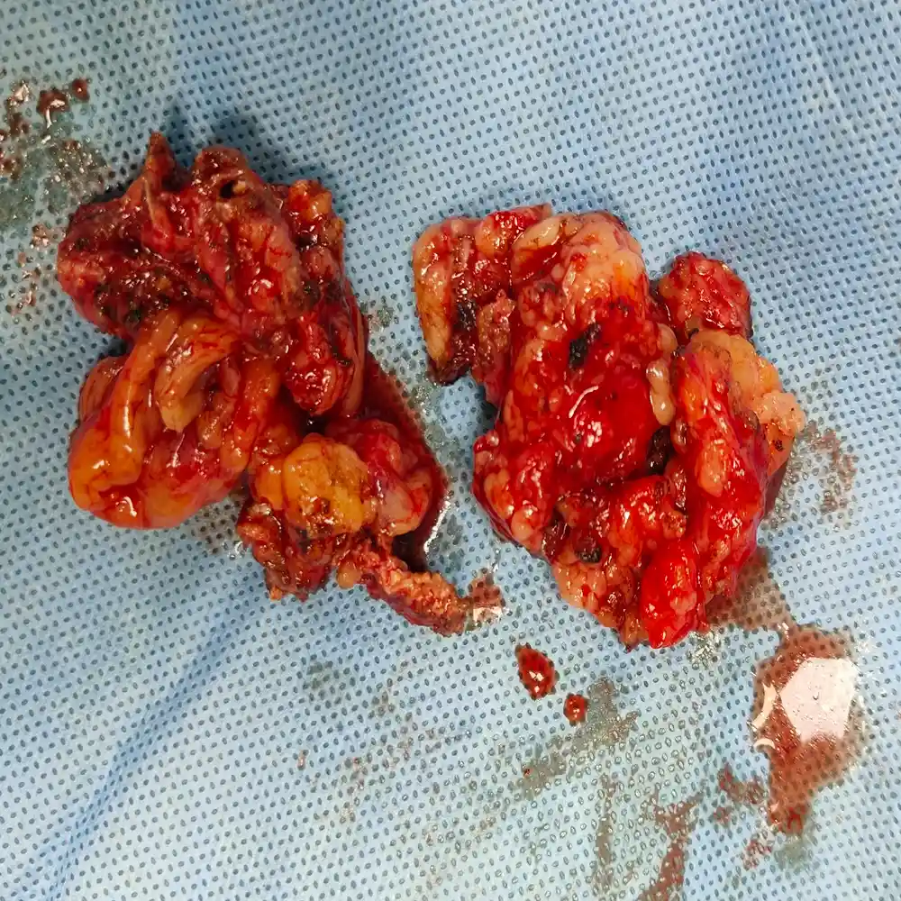 Robotic Retroperitoneal Lymph Node Dissection with Distal Pancreatectomy2