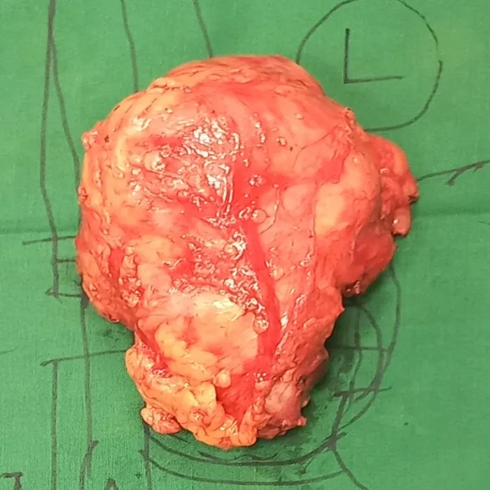 Robotic Retroperitoneal Mass Excision for a Complex Neural Spindle Cell Tumor 1