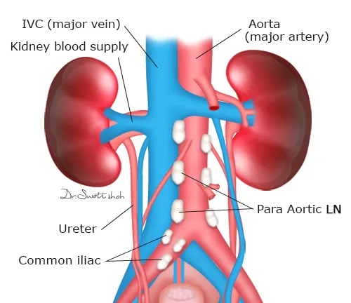 Retroperitoneal LND
